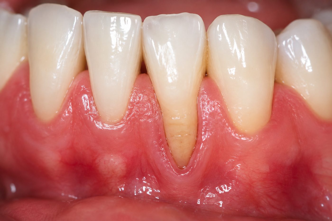 Receding gums explained by dentist at The White Dental Practice, your 'dental clinic near me', in Mankapur Nagpur