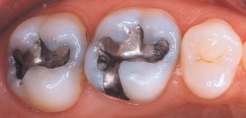 Are silver amalgam fillings safe explained by dentist at The White Dental Practice, your 'dental clinic near me', in Mankapur Nagpur