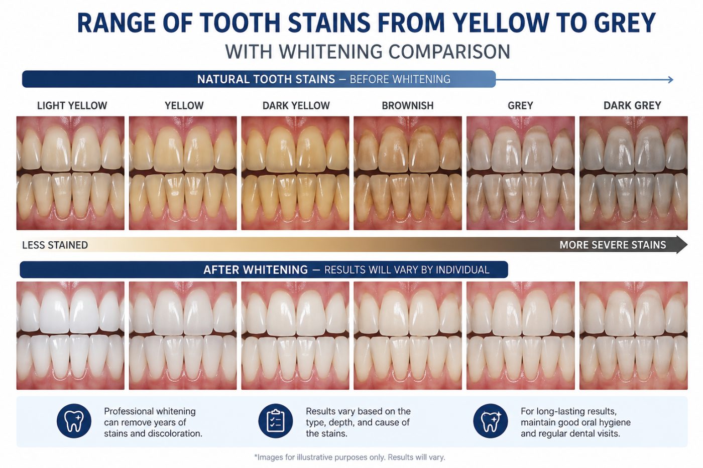Whitening stained and discoloured teeth explained by dentist at The White Dental Practice, your 'dental clinic near me', in Mankapur Nagpur