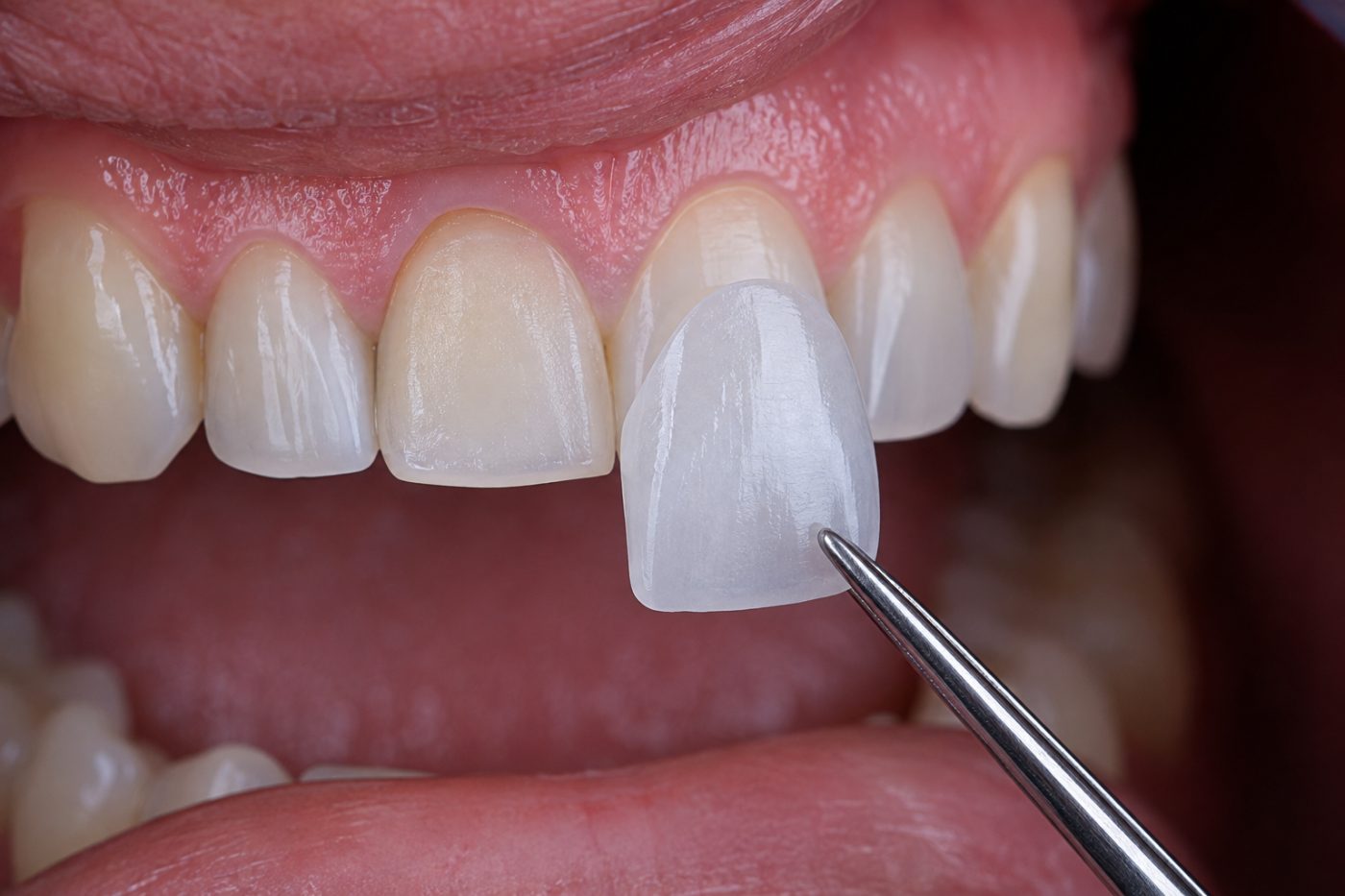 Dental veneers explained by dentist at The White Dental Practice, your 'dental clinic near me', in Mankapur Nagpur