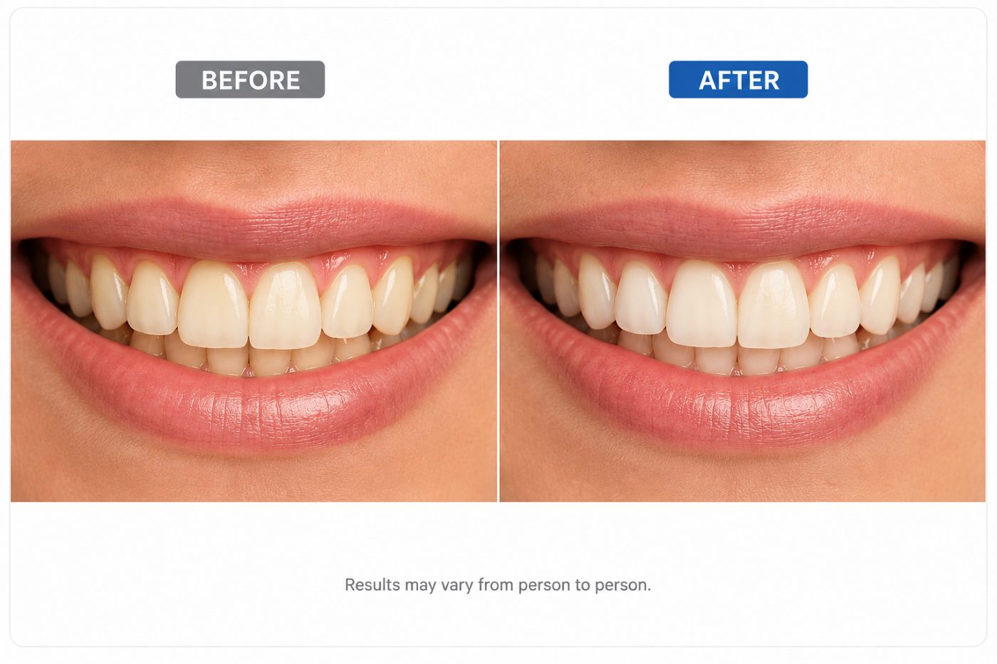 Does teeth whitening work shown by dentist at The White Dental Practice, your 'dental clinic near me', in Mankapur Nagpur