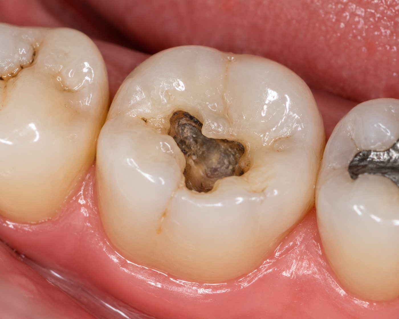 What to do when a filling falls out shown by dentist at The White Dental Practice, your 'dental clinic near me', in Mankapur Nagpur