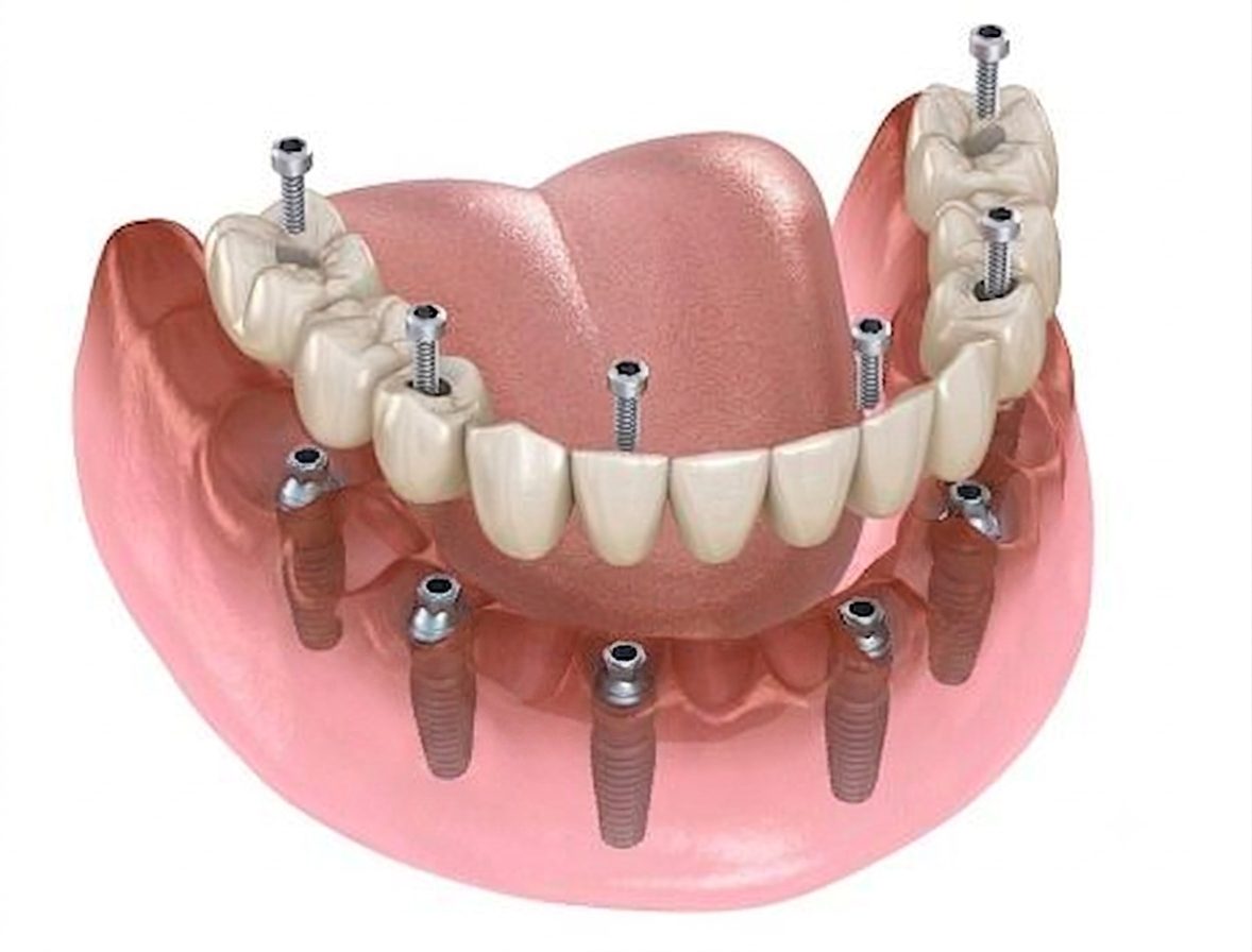 Full-mouth implants in one day explained by dentist at The White Dental Practice, your 'dental clinic near me', in Mankapur Nagpur