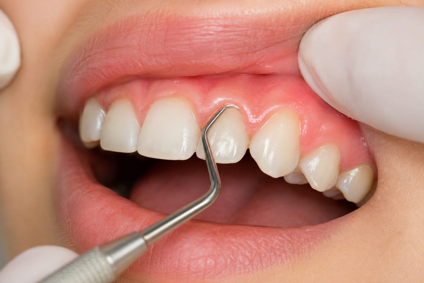 Signs of gum disease being checked by dentist at The White Dental Practice, your 'dental clinic near me', in Mankapur Nagpur