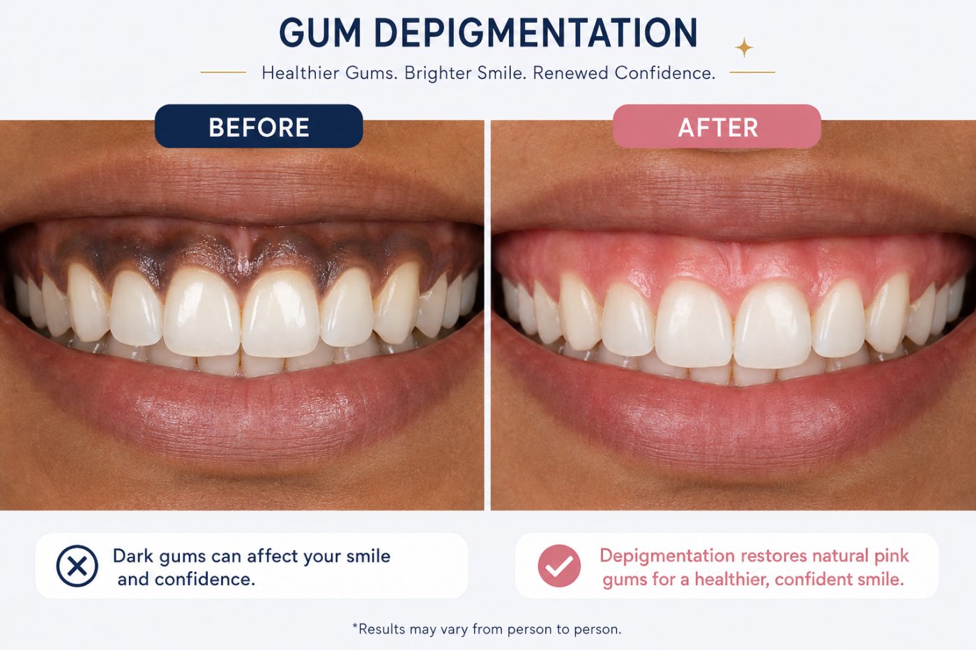 Dark gums and depigmentation explained by dentist at The White Dental Practice, your 'dental clinic near me', in Mankapur Nagpur