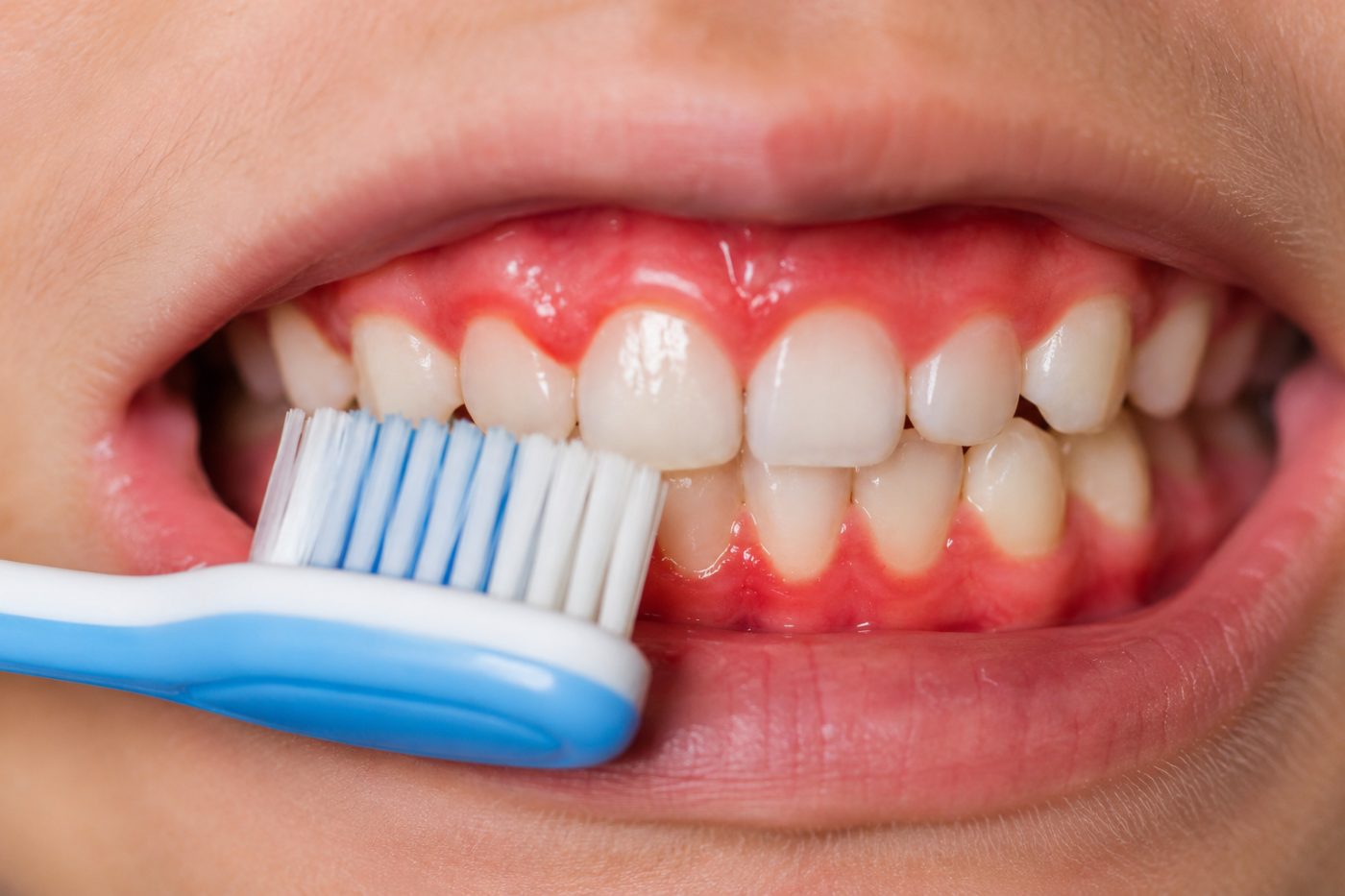 Bleeding gums when brushing explained by dentist at The White Dental Practice, your 'dental clinic near me', in Mankapur Nagpur