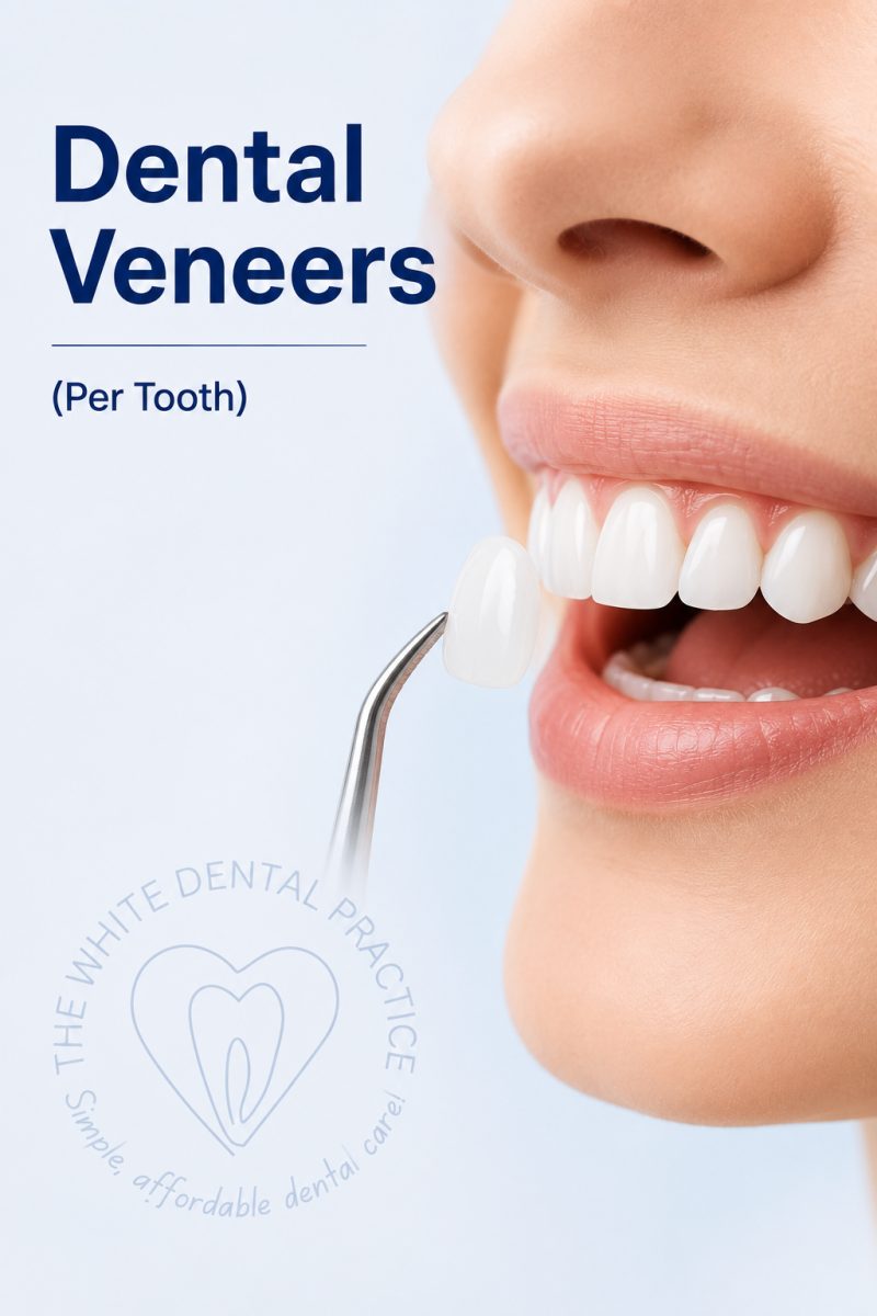 Dental Veneers with dentist at The White Dental Practice, dental clinic near me in Mankapur Nagpur