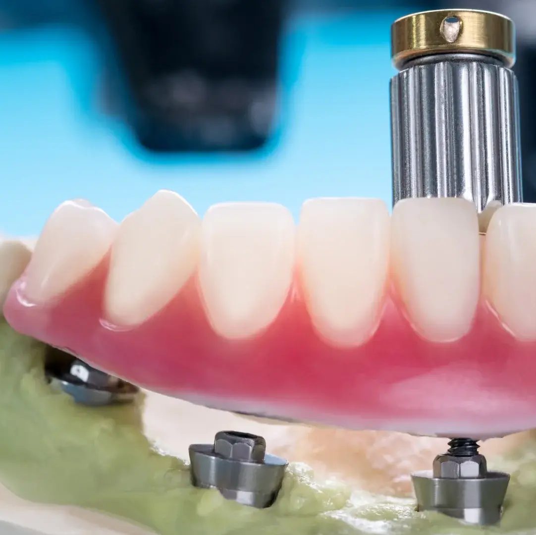 Full-Mouth Dental Implants (All-on-4 & All-on-6) with dentist at The White Dental Practice, dental clinic near me in Mankapur Nagpur