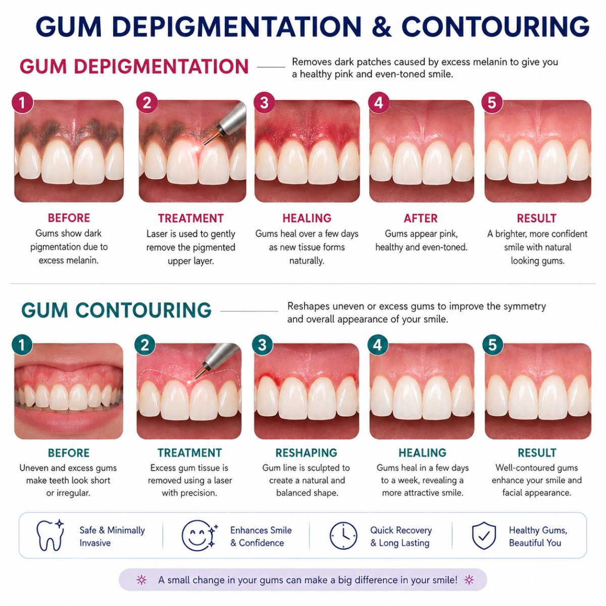 Gum Depigmentation & Contouring with dentist at The White Dental Practice, dental clinic near me in Mankapur Nagpur