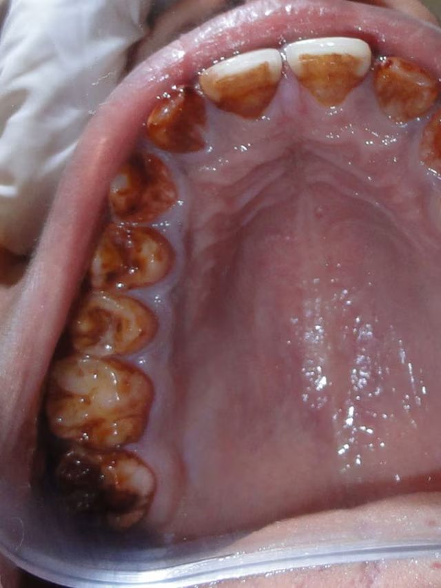 Oral Cancer & Oral Health Screening with dentist at The White Dental Practice, dental clinic near me in Mankapur Nagpur